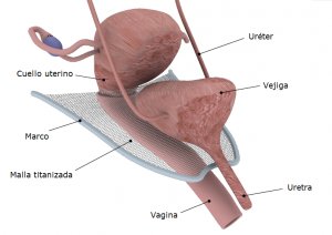 colposacropexia