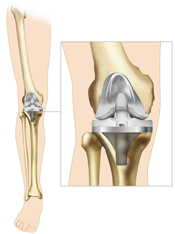artroplastia
