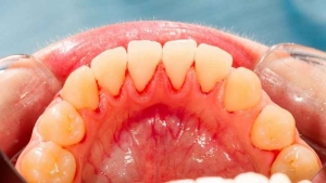 dentadura
